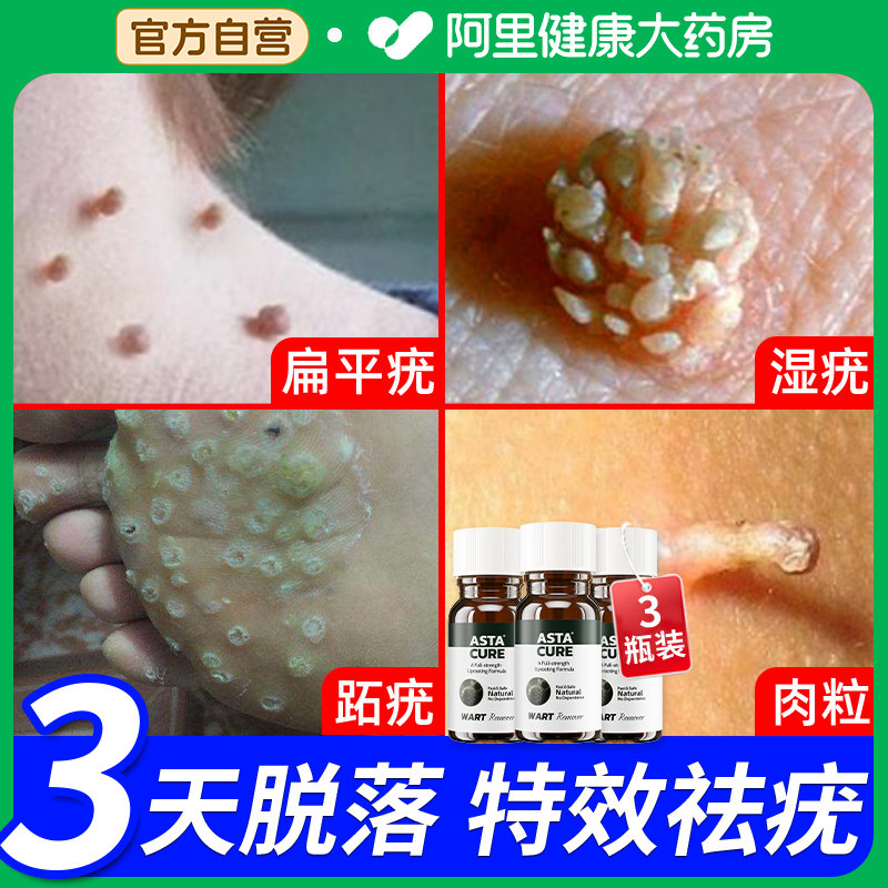 扁平疣去除膏乳膏鸡眼贴眼鸡眼膏去疣膏去扁平疣瘊子面部专用