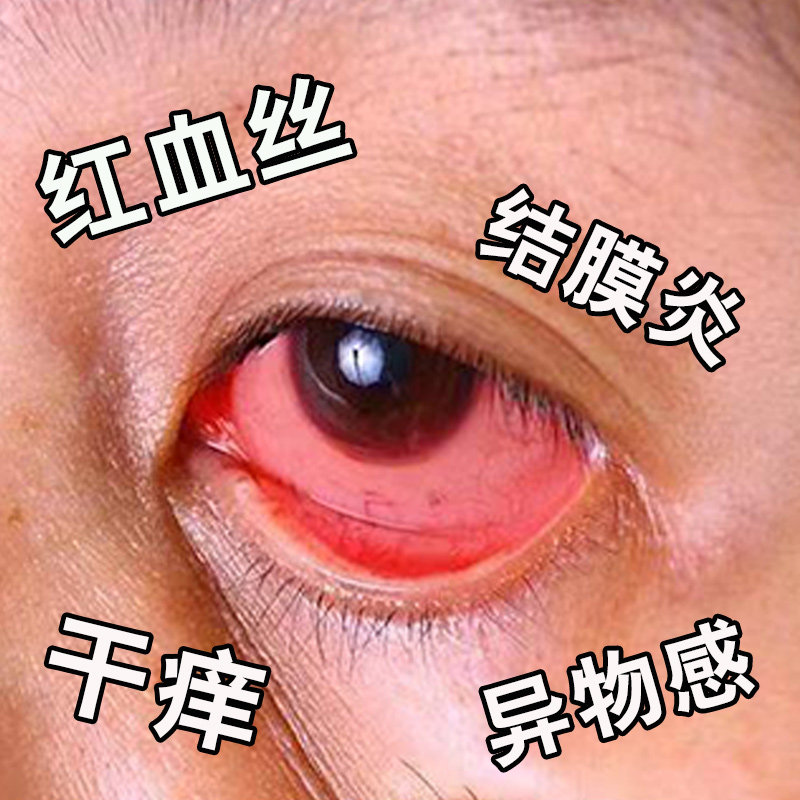 眼睛红血丝去除缓解眼红肿疲劳流泪干涩视模糊神器叶黄素眼药滴水