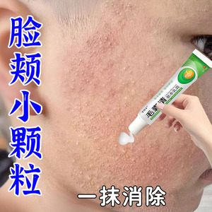 去除儿童脸上小颗粒毛周角化症膏