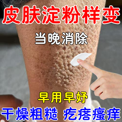 皮肤淀粉样变专用膏顽固皮藓止痒