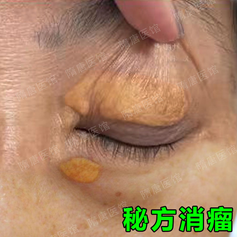 睑黄瘤膏去除睑黄瘤黄斑睑黄疣膏