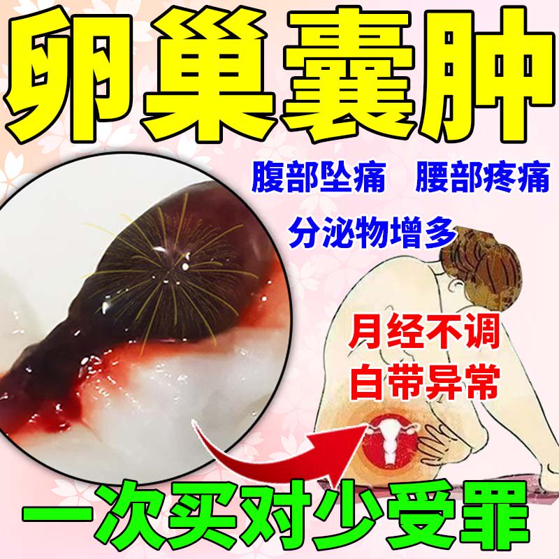 治疗卵巢囊肿的药巧克力子宫肌瘤中药贴调理月经不调痛经暖宫贴