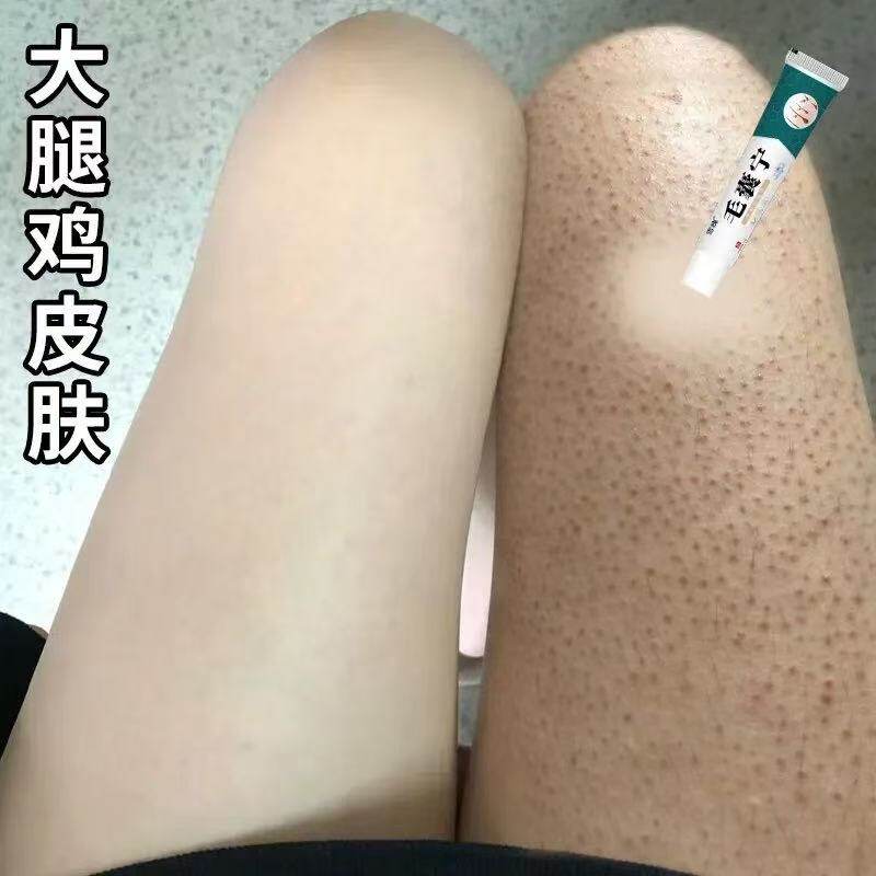 胳膊鸡皮肤疙瘩毛囊毛周角化去除症手臂脸上腿部胳膊红点黑点膏s