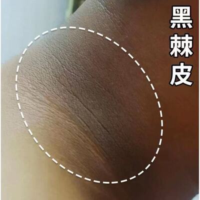 脖子黑色素去除黑棘皮病药膏颈部美白霜淡化身体皮肤沉淀修复神器