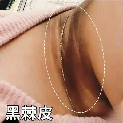 脖子黑色素去除黑棘皮病药膏颈部美白霜淡化身体皮肤沉淀修复神器