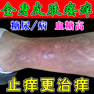 糖尿皮肤痒病止痒膏疗治老年人血糖皮肤瘙痒干燥脱皮溃烂专用膏药