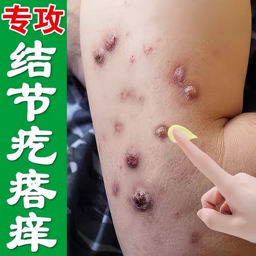 结节性痒疹特药效治顽固硬疙瘩皮肤身上起红点斑发痒外用修复软膏