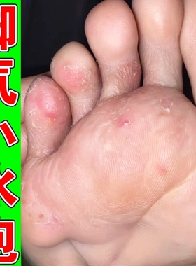 脚底起小水泡痒脚趾头缝脱皮掉皮烂脚丫脚臭真菌抓痒止痒杀菌乳膏