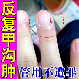 甲沟肿治疗专用指甲往肉里长息肉去除手脚指甲消肿嵌甲化脓止痛膏