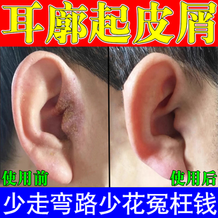 耳朵痒感染真菌外耳道皮屑干燥起皮流脓结痂霉菌性耳道痒专用乳膏
