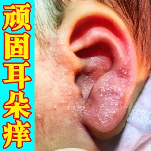 儿童耳朵痒中耳有炎专用膏药小孩耳道肤痒干燥起皮长小水泡耳痒膏