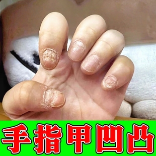 手指甲凹凸不平修复液脚趾甲表面凹陷有横纹翘起变形灰指甲修护药
