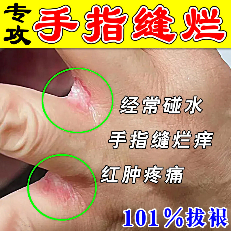烂手丫专用药手指缝溃烂手癣膏脱皮干裂真菌感染湿诊疹止痒去祛根