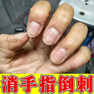去手指倒刺神器修复手干裂脱皮起硬皮脱皮防指甲边缘有肉刺去死皮