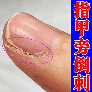手指倒刺营养油指甲边缘防干裂脱皮指甲缝有肉刺起皮裂纹修复神器