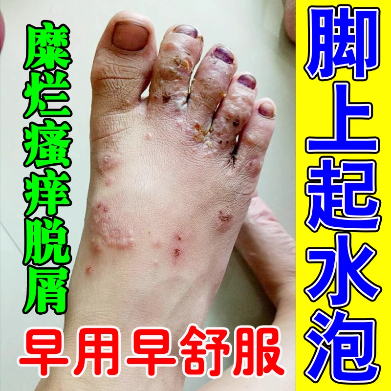 脚上起水泡痒水泡糜烂真菌感染红肿脚气脚臭起皮瘙痒抑菌止痒膏药