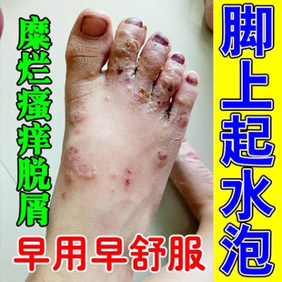 脚上起水泡痒水泡糜烂真菌感染红肿脚气脚臭起皮瘙痒抑菌止痒膏药