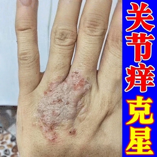 手指关节痒手鲜膏脱皮干裂真菌感染手痒神经性皮肤炎起皮修复膏药