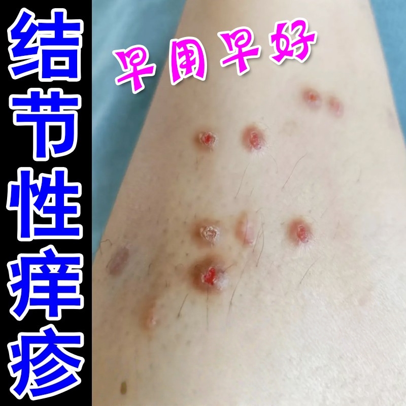 结节性痒疹效特治顽固硬疙瘩皮肤瘙痒身上起红斑湿痒效特止痒软膏