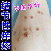 结节性痒疹效特治顽固硬疙瘩皮肤瘙痒身上起红斑湿痒效特止痒软膏