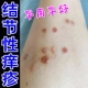 结节性痒疹效特治顽固硬疙瘩皮肤瘙痒身上起红斑湿痒效特止痒软膏