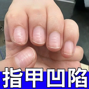 指甲凹凸不平修复液手脚指甲盖受损凹陷坑坑洼洼竖纹分层真菌感染