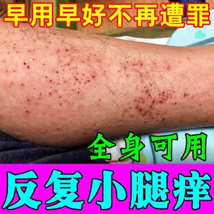 小腿皮肤痒起红疙瘩红点发痒秋冬换季腿部干燥起皮湿热过敏痒乳膏