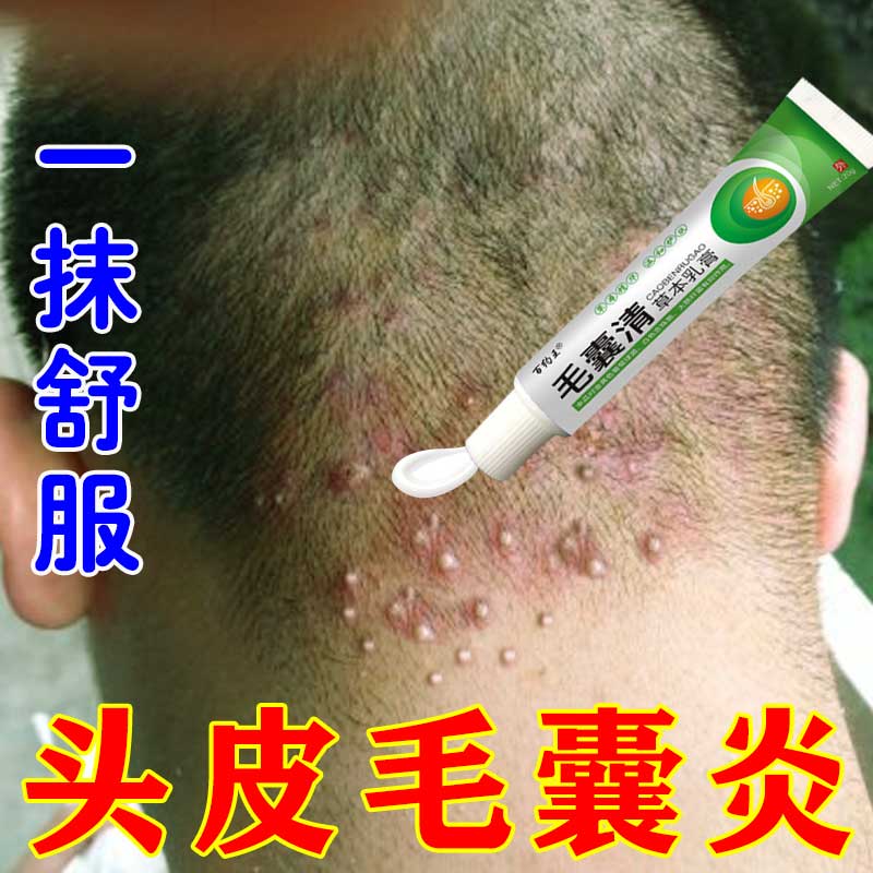 头皮毛囊炎头上长痘痘硬块疙瘩专用膏头部红肿起脓包毛囊发炎痒