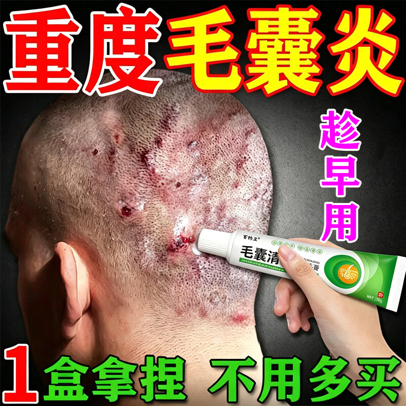 头皮毛囊焱专用膏头部脖子前胸后背私处长痘痘痒溢脂性毛囊藓乳膏