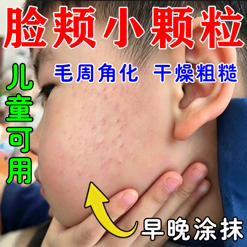 儿童毛周角化症膏去除脸部鸡皮肤脸上有小颗粒脸颊专用毛囊角质膏