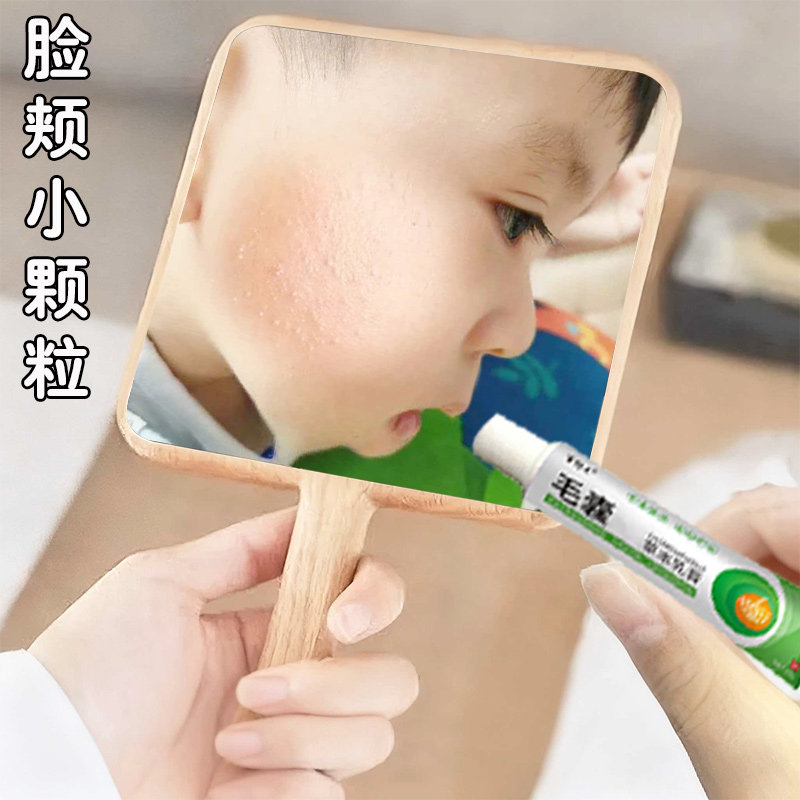 儿童毛周角化症膏去除脸部鸡皮肤脸上有小颗粒脸颊专用毛囊角质膏
