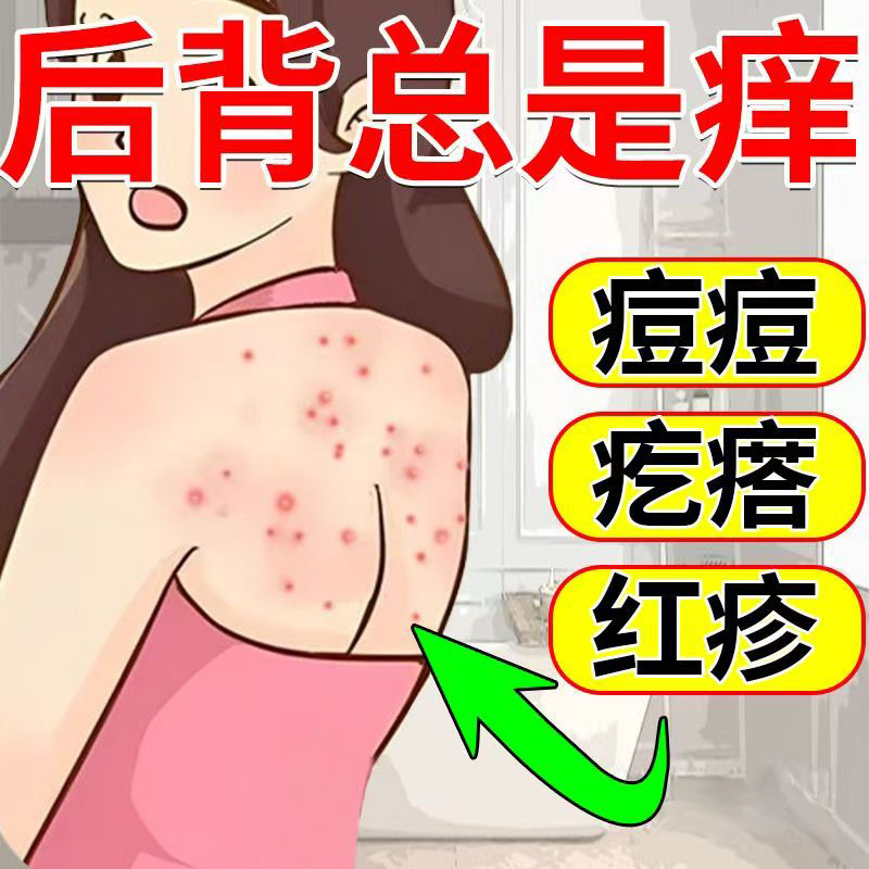 后背毛囊焱专用膏头部脖子前胸后背私处长痘痘痒溢脂性毛囊藓乳膏
