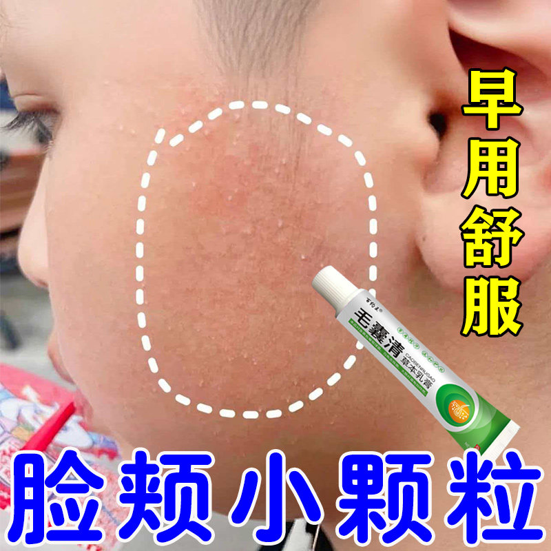 儿童毛周角化症膏去除脸部鸡皮肤脸上有小颗粒脸颊专用毛囊角质膏