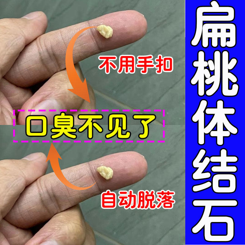 扁桃体结石漱口水去除工具口腔口臭喷剂隐窝咽喉清理冲洗神器吸取