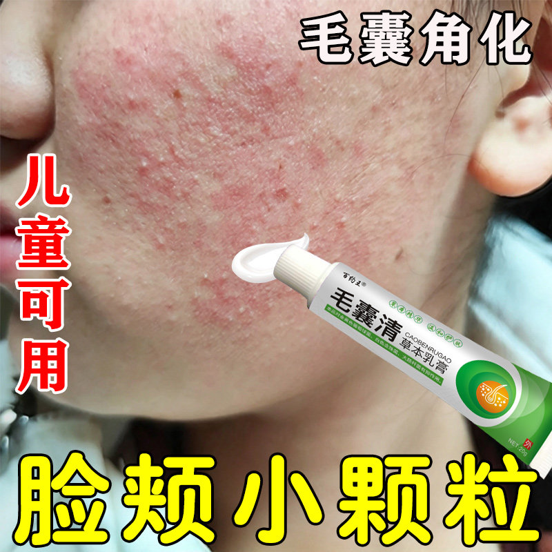 儿童毛周角化症毛囊脸部鸡皮肤脸上有小颗粒起小疙瘩毛囊堵塞专用