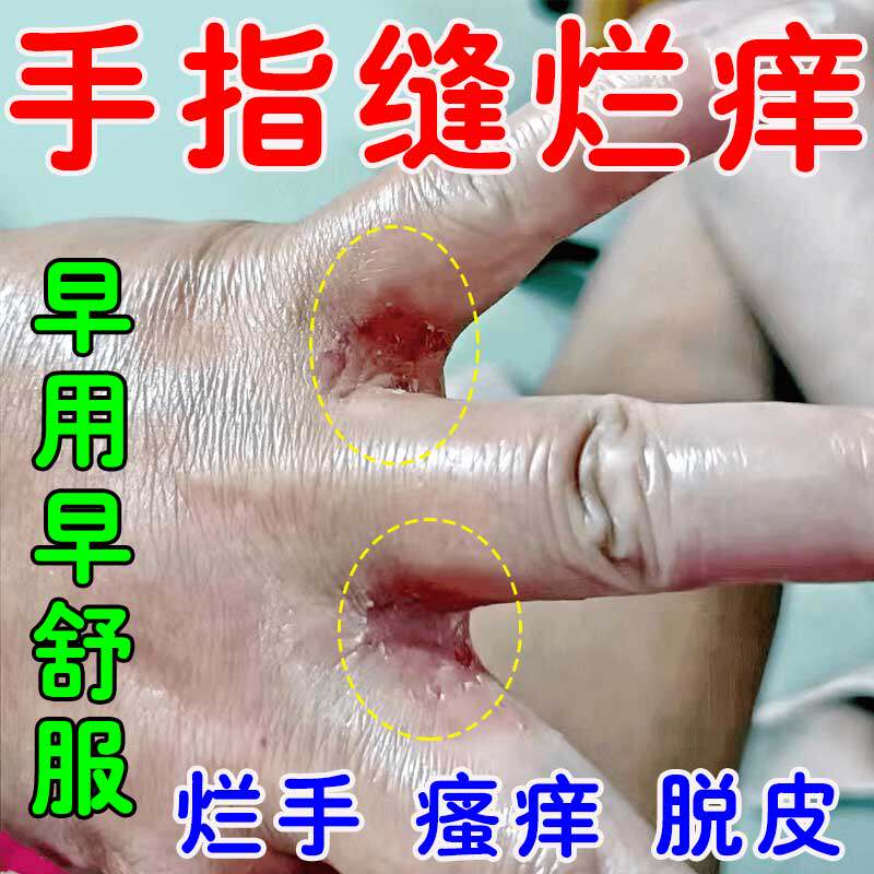手指缝烂痒长期泡水烂手丫专用膏真菌感染手气手指缝溃烂瘙痒起皮