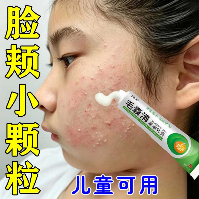 脸颊小颗粒毛囊角化专用膏