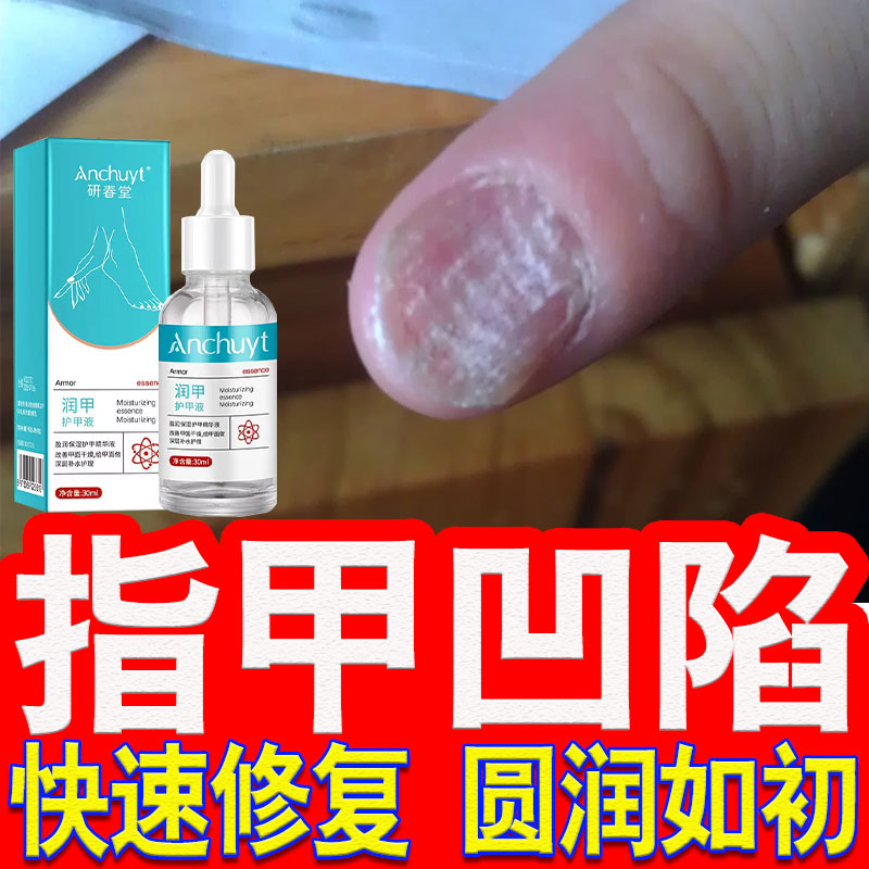 受损指甲凹陷变形坑洼手指甲凹凸不平萎缩修复液手指脚趾甲营养液