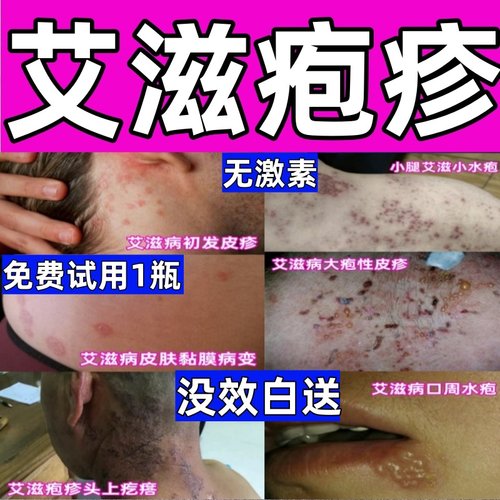 治艾滋疱疹梅毒病毒感染溃烂急性黏膜湿疣皮疹止痒外用涂抹药膏