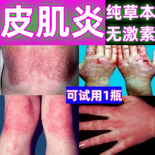 治皮肌炎多发性无肌性肌炎特效药成人儿童紫红色丘疹红斑银屑药膏