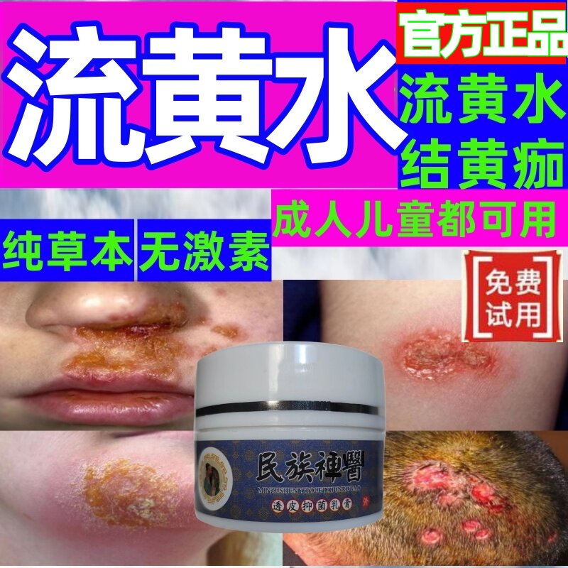 治黄水疮药膏黄皮疮鼻子溃疡鼻孔溃烂伤口流黄水化脓性脓包疮外用
