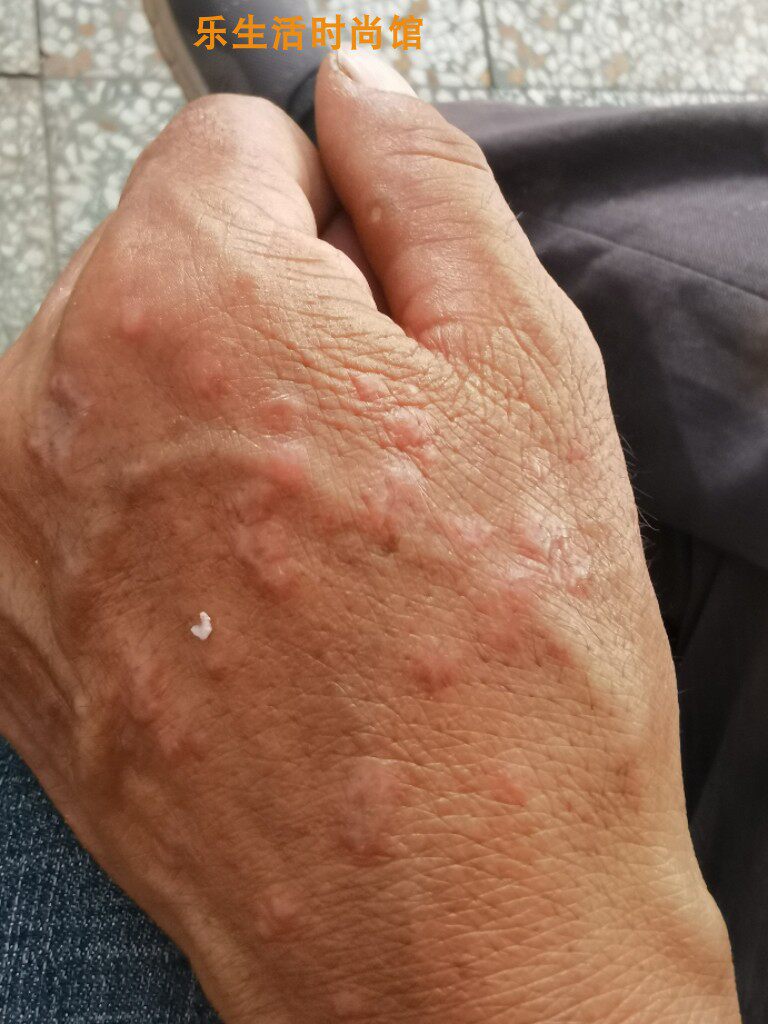 大腿内侧红斑牛皮癣苗师医太宫廷御医本草膏皮肤抑菌止痒药膏软膏