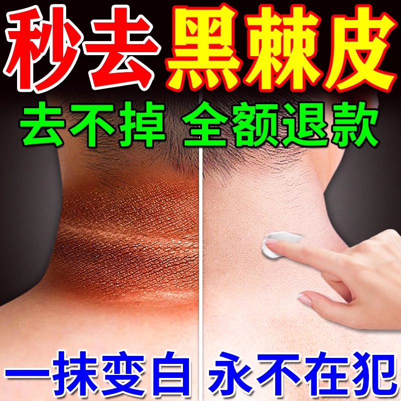 脖子黑色素去除颈部变白霜神器皮肤黑色素沉淀去脖子黑棘皮病药膏