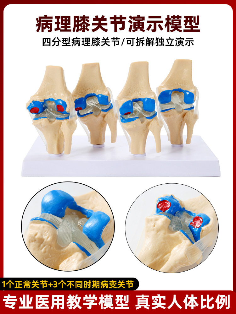 人体四阶段病理膝关节骨骼结构解剖模型骨科展示膝关节教学模具
