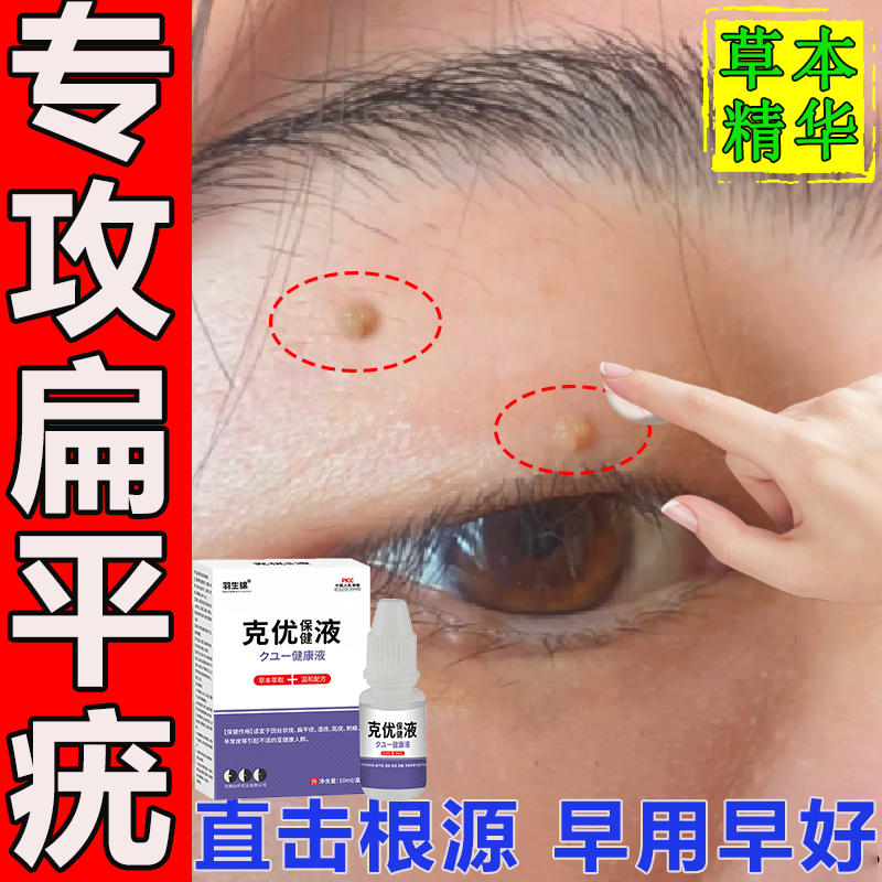扁平疣湿疣去除药水一抹灵治疗祛除脸上面部脖子小肉粒瘊子丝状疣