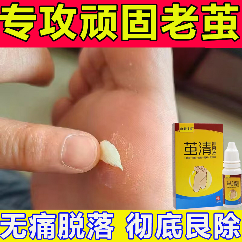 去老茧脚底脚垫厚茧鸡眼膏脚后跟脚掌死皮硬皮脚趾关节茧去茧神器