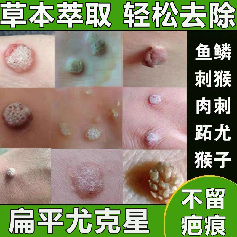 扁平疣湿疣去除药水一抹灵治疗祛除脸上面部脖子小肉粒瘊子丝状疣
