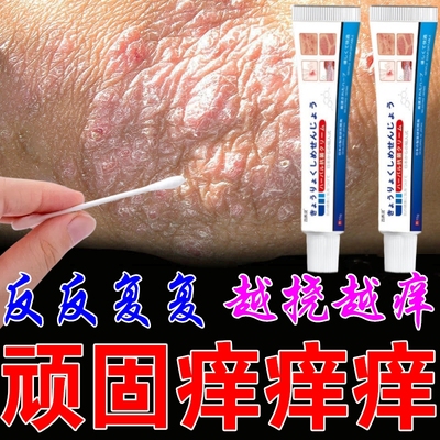日本手肘癣专用膏药关节藓真菌脱皮干裂长硬疙瘩手藓手气瘙痒止痒