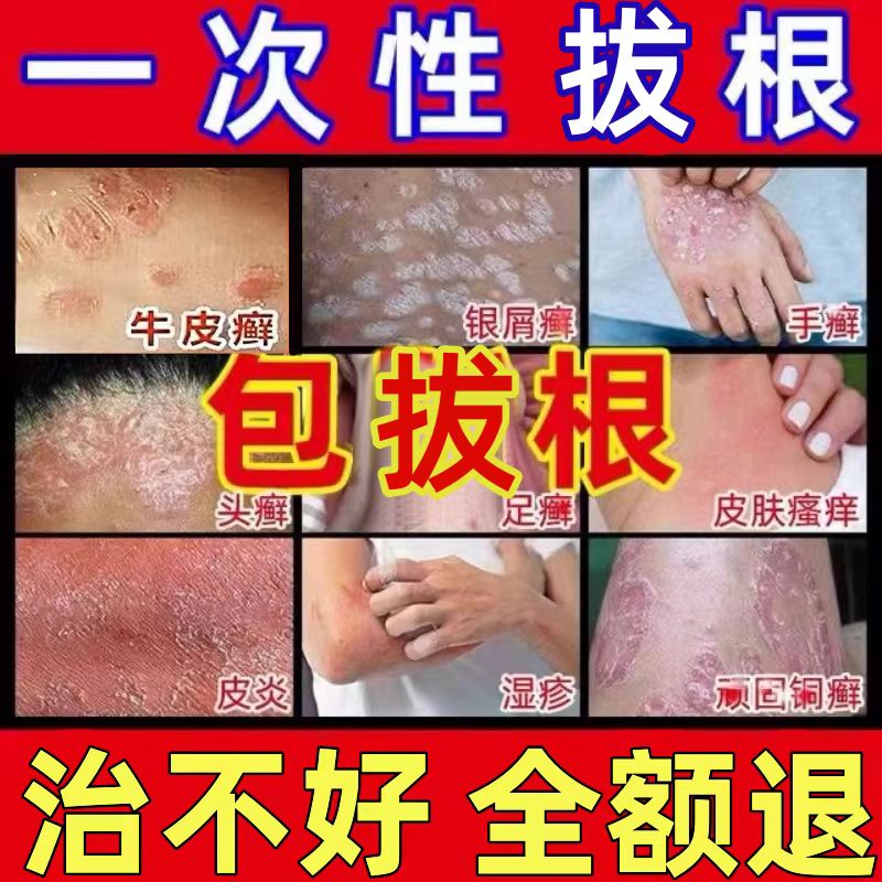 苗家牛皮癣银屑病股藓止湿疹痒根去外用药皮肤瘙抑菌痒专用效特膏