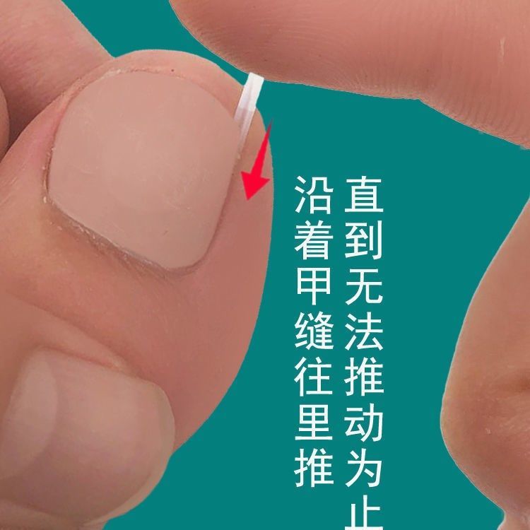 趾甲矫正器甲沟炎专用大脚趾内生隔离填充垫神器实用脚部护理